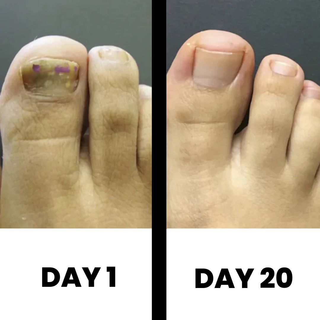 DermaNail – Patented nail fungus therapy – for healthy nails within 4 weeks Success