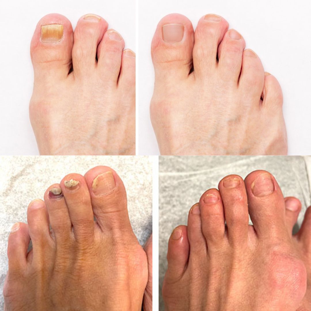 DermaNail – Patented nail fungus therapy – for healthy nails within 4 weeks Success